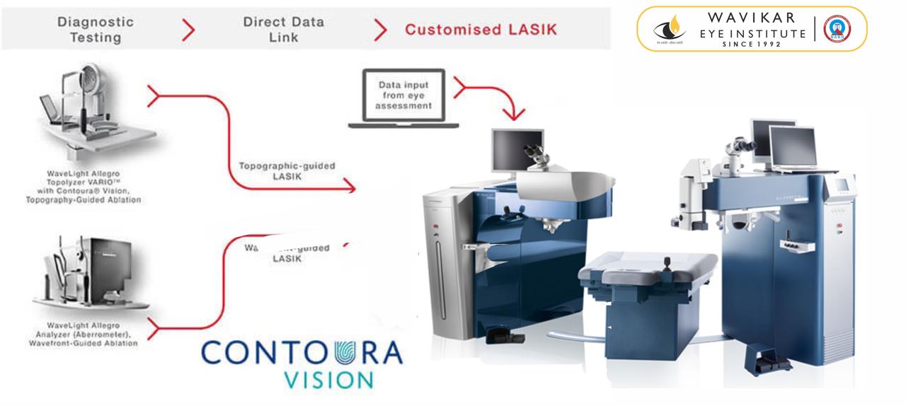Contoura Vision Lasik